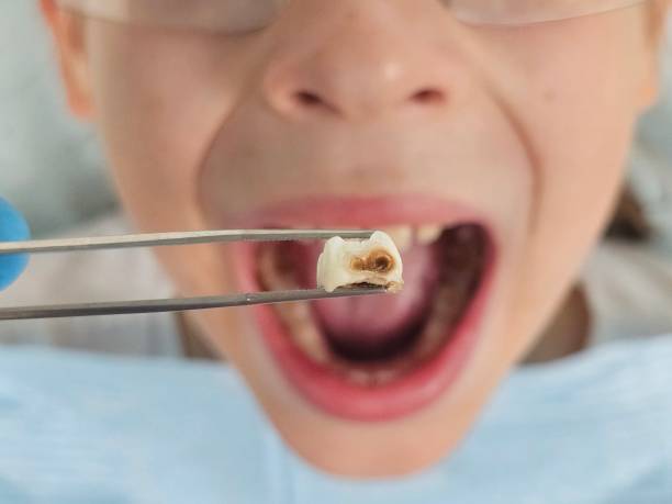Best Emergency Dental Extractions in Buffalo, SC